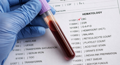 Чому результати аналізів можуть коливатись: стрес, сон, фізичні навантаження, ліки