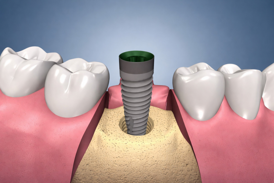Імплантація одразу після видалення: що відбувається за один візит