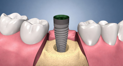 Імплантація одразу після видалення: що відбувається за один візит