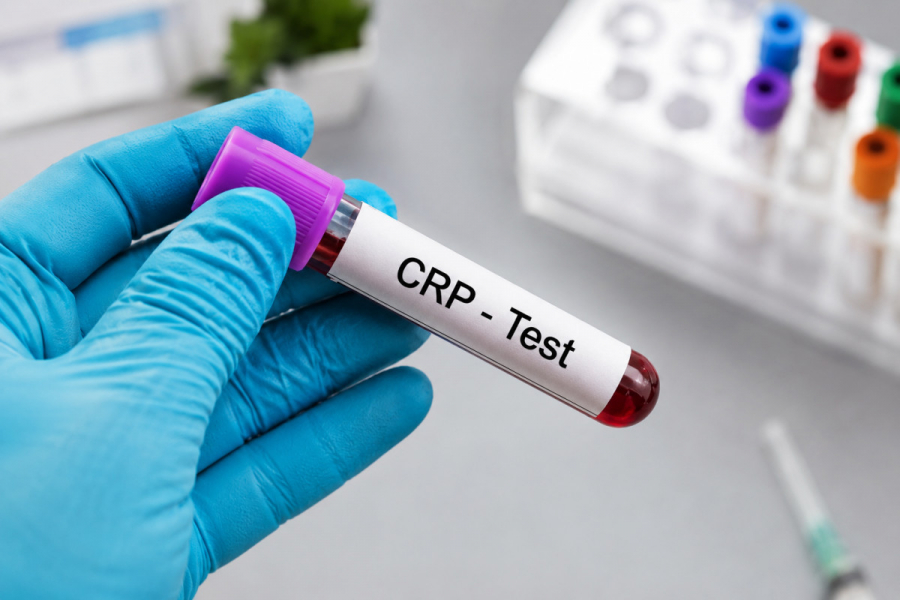 Високочутливий C-реактивний білок (hs CRP)