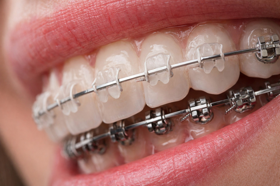 Все, що потрібно знати про брекети перед початком лікування?