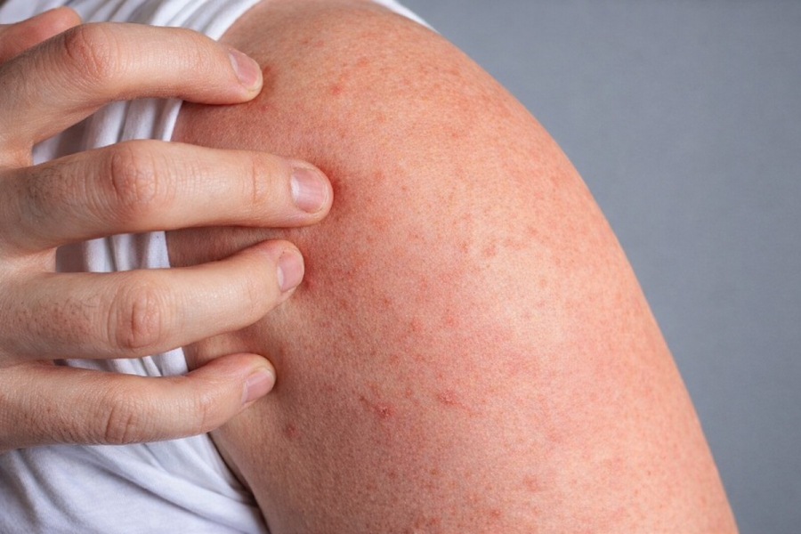 Як жити з псоріазом і не відчувати дискомфорт