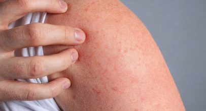 Як жити з псоріазом і не відчувати дискомфорт