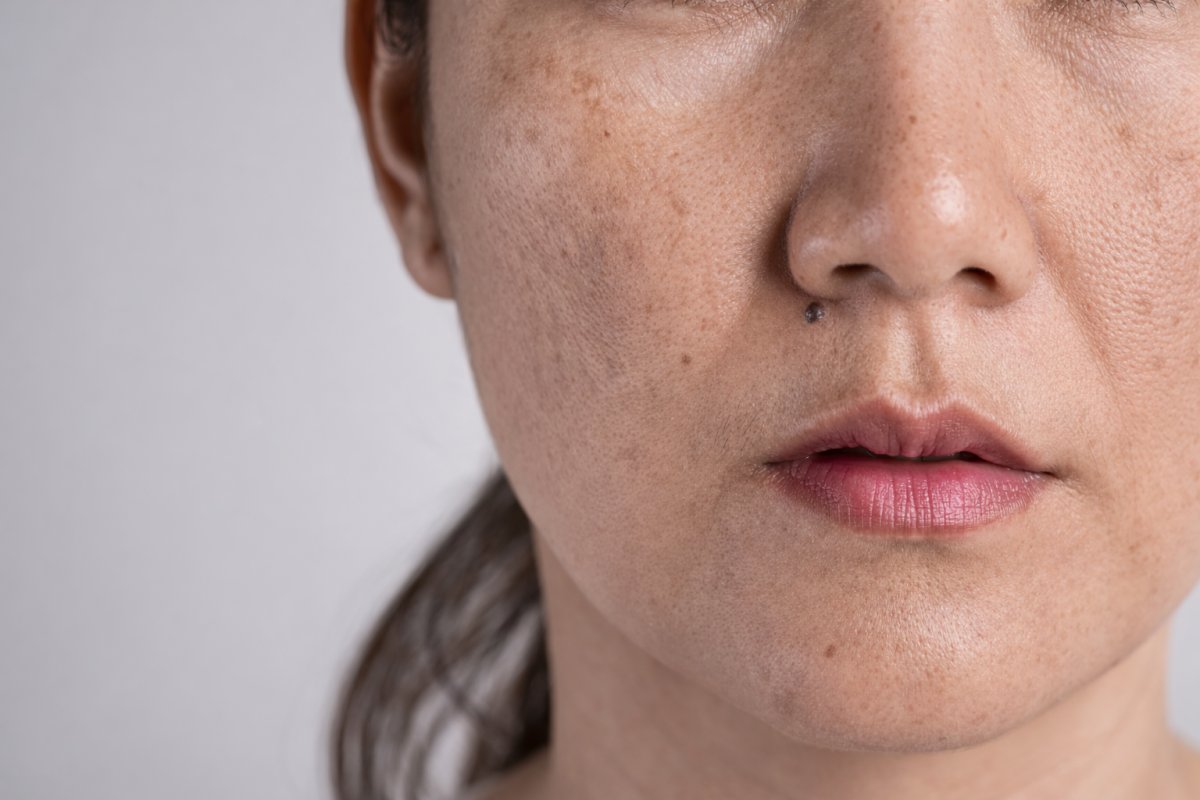 Почему появляются пигментные пятна