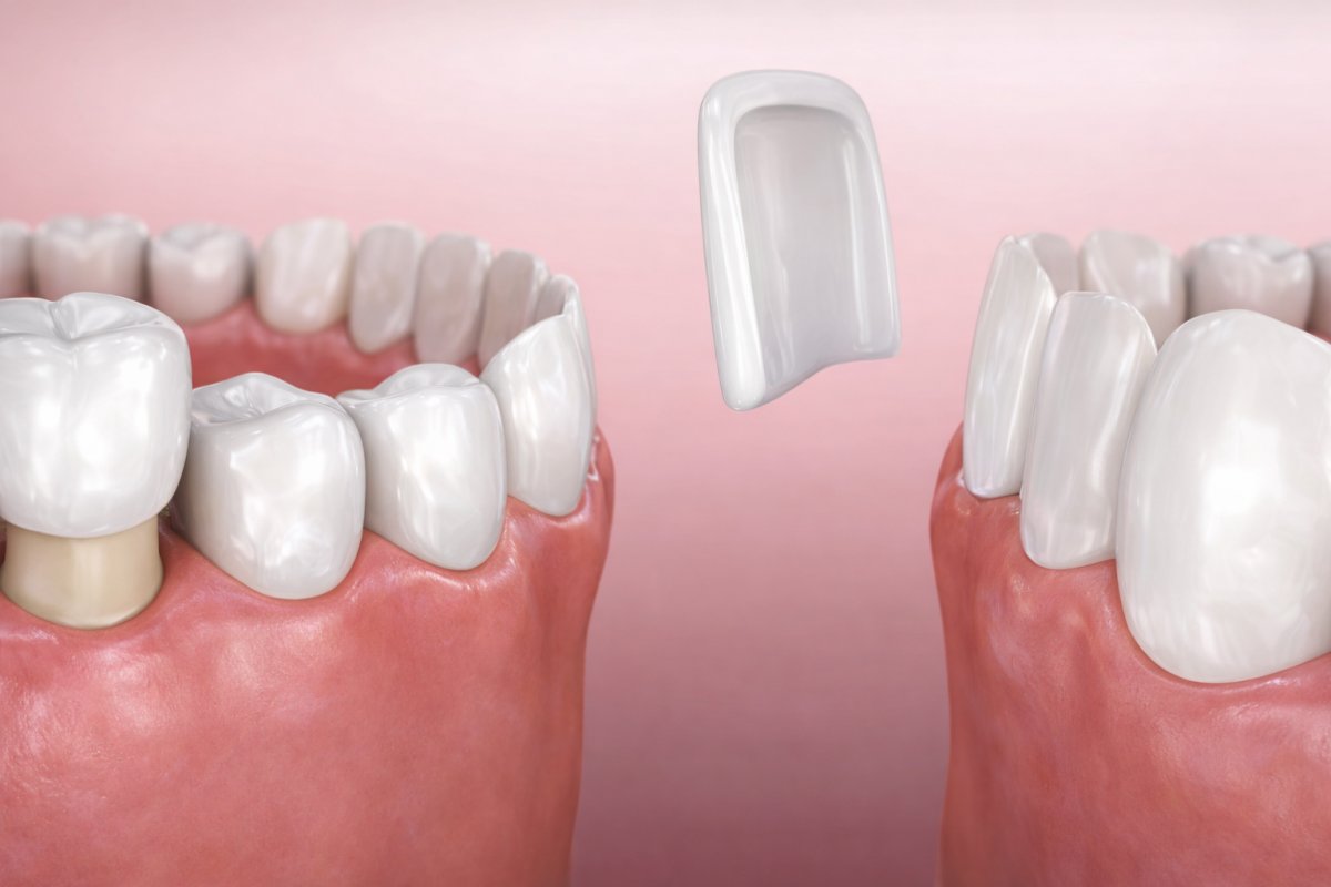 Когда лучше выбрать виниры Когда лучше выбрать виниры