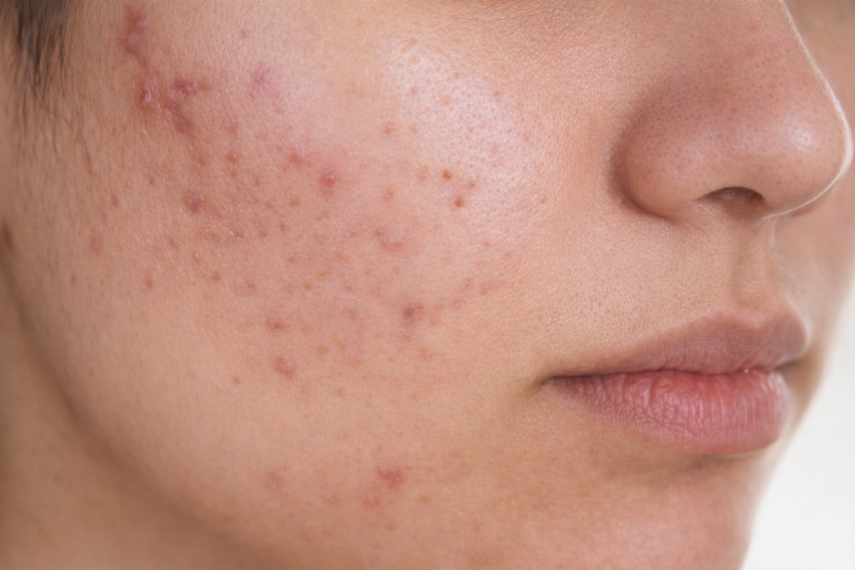 Основні причини появи прищів