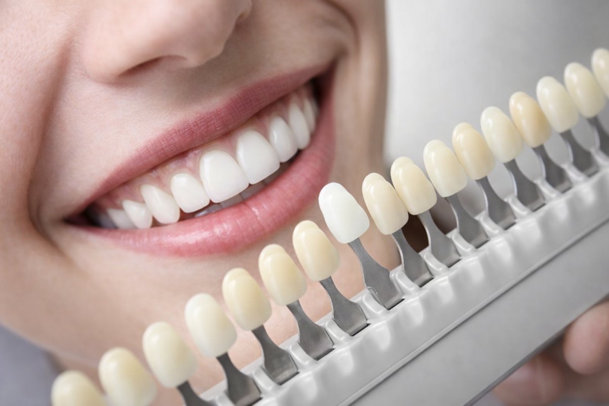 Плюсы и минусы виниров и коронок Плюсы и минусы виниров и коронок