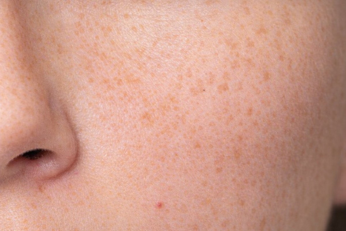 Что такое пигментные пятна